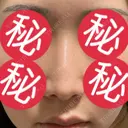 その他（鼻） 聖心美容クリニック 大阪院 AFTER サムネイル用