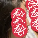 その他（鼻） 聖心美容クリニック 大阪院 DAY 78 サムネイル用