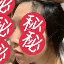 その他（鼻） 聖心美容クリニック 大阪院 DAY 78 サムネイル用