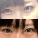 蒙古ひだ形成 R.O.clinic DAY 29 サムネイル用