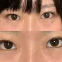 蒙古ひだ形成 R.O.clinic DAY 29 サムネイル用