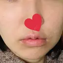 シミ取りレーザー / ピコレーザートーニング（美白・肝斑） UB CLINIC銀座 DAY 14 サムネイル用