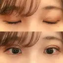 二重埋没 湘南美容クリニック 金沢院 DAY 7 サムネイル用