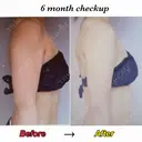 脂肪吸引（二の腕） Mods Clinic（モッズクリニック） 東京院 AFTER サムネイル用