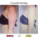 脂肪吸引（二の腕） Mods Clinic（モッズクリニック） 東京院 DAY 190 サムネイル用