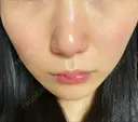 フォトRF 湘南美容クリニック 柏院 AFTER サムネイル用