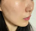 フォトRF 湘南美容クリニック 柏院 DAY 11 サムネイル用