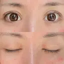 二重切開 / 眼瞼下垂（切開） / 目元修正 シエルクリニック AFTER サムネイル用