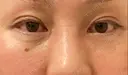 下まぶたたるみ取り / 下まぶたの脂肪取り ヨーダー公子クリニック眼科・美容皮膚科 横浜六浦院 DAY 31 サムネイル用