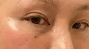 下まぶたたるみ取り / 下まぶたの脂肪取り ヨーダー公子クリニック眼科・美容皮膚科 横浜六浦院 DAY 31 サムネイル用