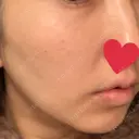 シミ取りレーザー / ピコレーザートーニング（美白・肝斑） UB CLINIC銀座 DAY 16 サムネイル用