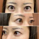 糸リフト / クマ治療 / 額を丸く / その他（輪郭） / こめかみ形成 / 脂肪注入（額） / 脂肪注入（輪郭） / その他（口元） 湘南美容クリニック 品川院 AFTER サムネイル用