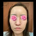 糸リフト / クマ治療 / 額を丸く / その他（輪郭） / こめかみ形成 / 脂肪注入（額） / 脂肪注入（輪郭） / その他（口元） 湘南美容クリニック 品川院 DAY 35 サムネイル用