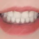 骨切り（あご） / 骨削り（頬） / ガミースマイル手術 / ルフォー+ssro（両あご) ウォンジン（Wonjin）整形外科 DAY 366 サムネイル用