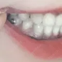 骨切り（あご） / 骨削り（頬） / ガミースマイル手術 / ルフォー+ssro（両あご) ウォンジン（Wonjin）整形外科 DAY 366 サムネイル用