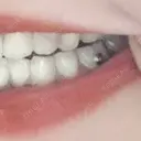 骨切り（あご） / 骨削り（頬） / ガミースマイル手術 / ルフォー+ssro（両あご) ウォンジン（Wonjin）整形外科 DAY 366 サムネイル用