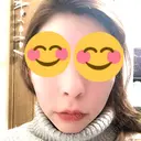 骨切り（あご） / 骨削り（頬） / ガミースマイル手術 / ルフォー+ssro（両あご) ウォンジン（Wonjin）整形外科 AFTER サムネイル用