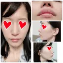 鼻中隔延長（切開） / 軟骨移植 / 鼻修正 / 傷跡修正 神戸大学附属病院 美容外科 AFTER サムネイル用