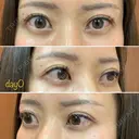 二重埋没 湘南美容クリニック 品川院 DAY 0 サムネイル用