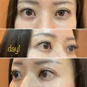 二重埋没 湘南美容クリニック 品川院 DAY 1 サムネイル用