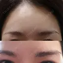 眉下切開 エイペックス美容外科 DAY 54 サムネイル用