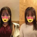 目尻切開 / タレ目形成・グラマラスライン（切開） B-LINE CLINIC 池袋院 DAY 5 サムネイル用