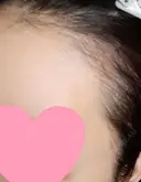 アートメイク（ヘアライン） トイトイトイクリニック 池袋院 DAY 16 サムネイル用