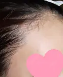 アートメイク（ヘアライン） トイトイトイクリニック 池袋院 DAY 16 サムネイル用