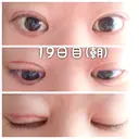 二重切開 / 眼瞼下垂（切開） 新前橋かしま眼科形成外科クリニック DAY 19 サムネイル用