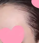 アートメイク（ヘアライン） トイトイトイクリニック 池袋院 DAY 17 サムネイル用