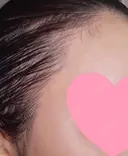 アートメイク（ヘアライン） トイトイトイクリニック 池袋院 DAY 17 サムネイル用