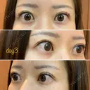 二重埋没 湘南美容クリニック 品川院 DAY 3 サムネイル用