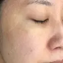 シミ取りレーザー / YAGレーザー 仁愛クリニック DAY 51 サムネイル用