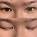 二重埋没 / 二重切開 宇都宮竹内クリニック DAY 6 サムネイル用