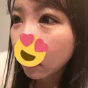 目尻切開 / タレ目形成・グラマラスライン（切開） B-LINE CLINIC 池袋院 DAY 6 サムネイル用