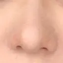 鼻尖形成（切開） / 軟骨移植 白山クリニック 大分 DAY 31 サムネイル用