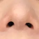 鼻尖形成（切開） / 軟骨移植 白山クリニック 大分 DAY 31 サムネイル用