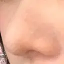 鼻尖形成（切開） / 軟骨移植 白山クリニック 大分 DAY 31 サムネイル用