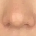 鼻尖形成（切開） / 軟骨移植 白山クリニック 大分 DAY 36 サムネイル用