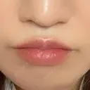 ヒアルロン酸注入（唇） / ボトックス（口角） アネシス美容クリニック DAY 0 サムネイル用