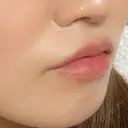 ヒアルロン酸注入（唇） / ボトックス（口角） アネシス美容クリニック DAY 0 サムネイル用