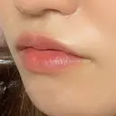 ヒアルロン酸注入（唇） / ボトックス（口角） アネシス美容クリニック DAY 0 サムネイル用