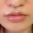 ヒアルロン酸注入（唇） / ボトックス（口角） アネシス美容クリニック DAY 2 サムネイル用
