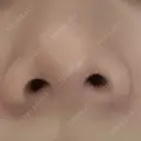 鼻尖形成（切開） / 軟骨移植 白山クリニック 大分 AFTER サムネイル用