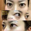 二重埋没 湘南美容クリニック 品川院 DAY 5 サムネイル用