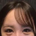 目尻切開 / タレ目形成・グラマラスライン（切開） B-LINE CLINIC 池袋院 DAY 7 サムネイル用