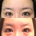 目尻切開 / タレ目形成・グラマラスライン（切開） B-LINE CLINIC 池袋院 DAY 8 サムネイル用