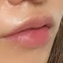 ヒアルロン酸注入（唇） / ボトックス（口角） アネシス美容クリニック DAY 3 サムネイル用