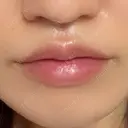 ヒアルロン酸注入（唇） / ボトックス（口角） アネシス美容クリニック AFTER サムネイル用