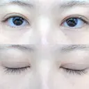 二重切開 松下皮フ形成外科 AFTER サムネイル用